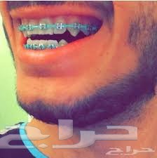 تقويم الأسنان يتركب بالبيت 250 ريال