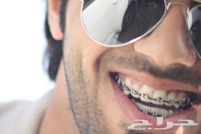 تقويم الأسنان يتركب بالبيت 250 ريال